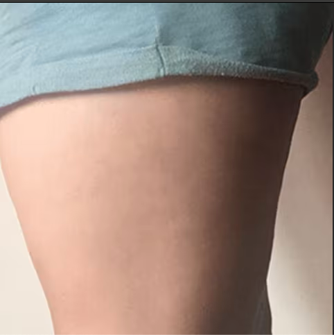 Thigh after