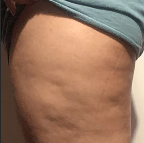 Thigh before