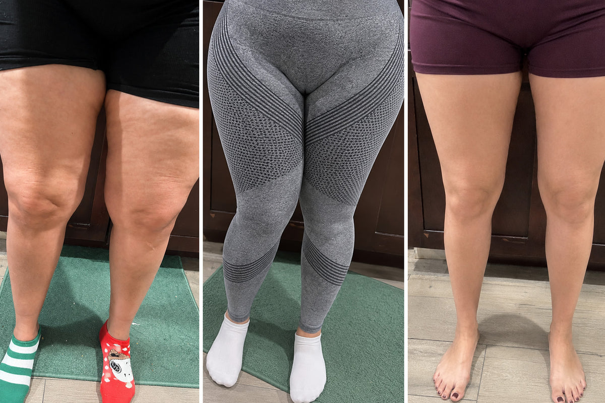Comparison of compression leggings for lipedema