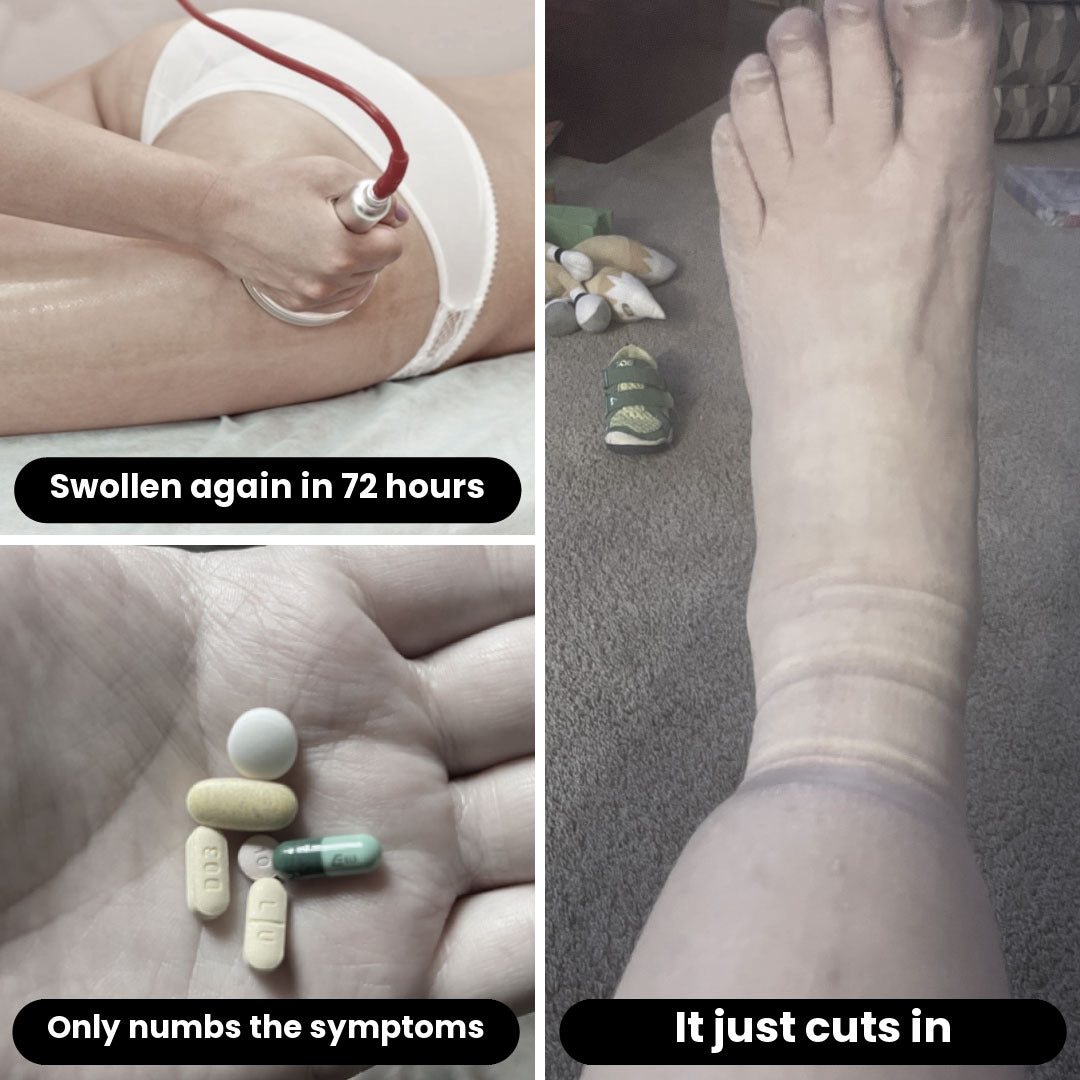 Compression treatment for lipedema