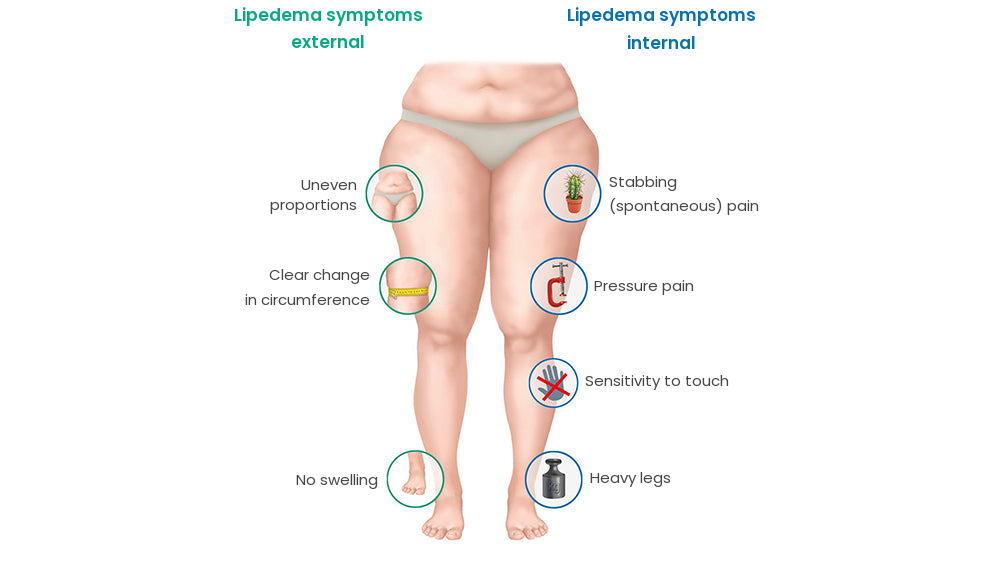 Lipedema symptoms, external and internal