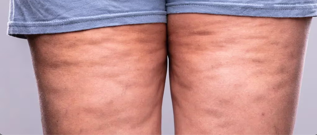 Close up of legs with uneven skin
